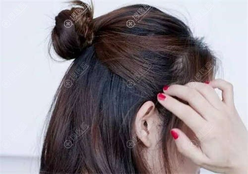 韩国修复双眼皮费用高吗(变美:韩式双眼皮手术费)